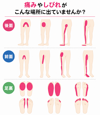 院長自身の坐骨神経痛体験 概要 若い頃から続く腰痛、そして悪化していった坐骨神経痛。