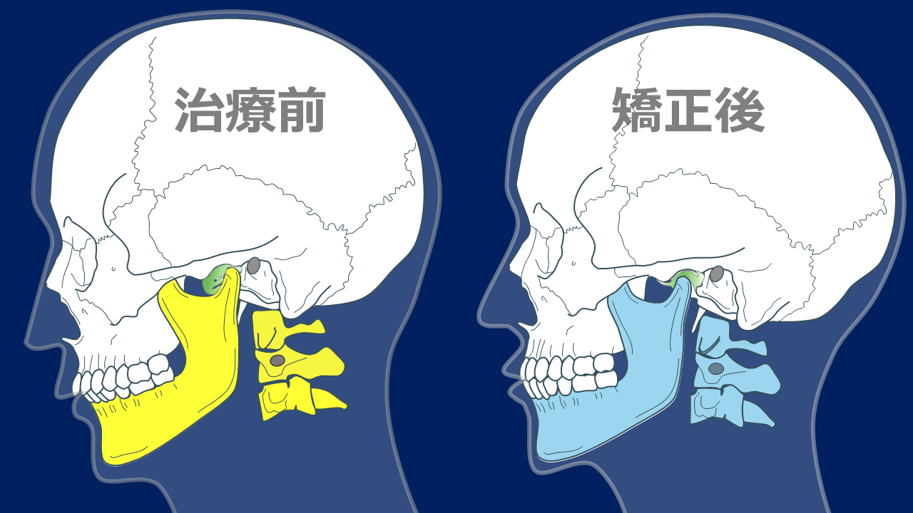 私が行きついた噛み合わせを治す方法とは？