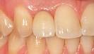 nicht von den natürlichen Zähnen zu unterscheidende Krone auf dem Implantat
