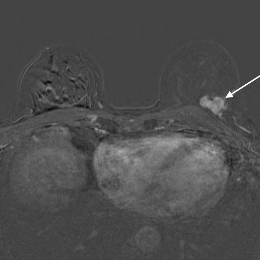 BREAST Imaging internationalradiologys seite!
