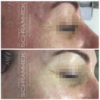 Haarentfernung kosmetikbedarf Gesichtsbehandlung Antiaging needling GreenPeel Microdermabrasion LPG Endermologie Akne Gesichtsbehandlung Sofrischweiz Aknebehandlung Fusspflege Farblichttherapie kosmetik Gesichtsbehandlung Aknebehandlung Akne LPG Lymphomat
