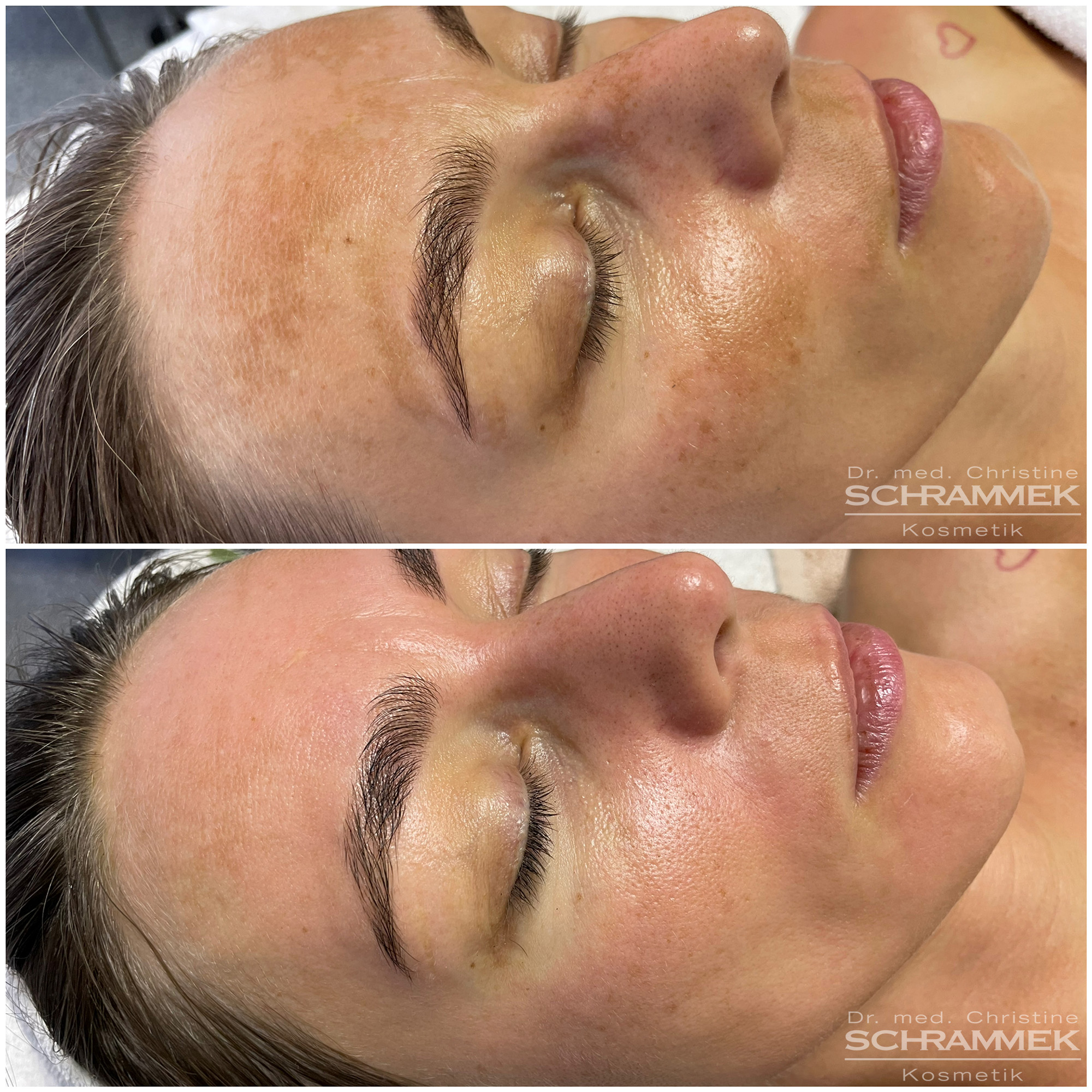 Haarentfernung kosmetikbedarf gesichtsbehandlung Antiaging needling GreenPeel Microdermabrasion LPG Endermologie Akne Gesichtsbehandlung Sofrischweiz Aknebehandlung Fusspflege Farblichttherapie kosmetik Gesichtsbehandlung Aknebehandlung Akne LPG Lymphomat
