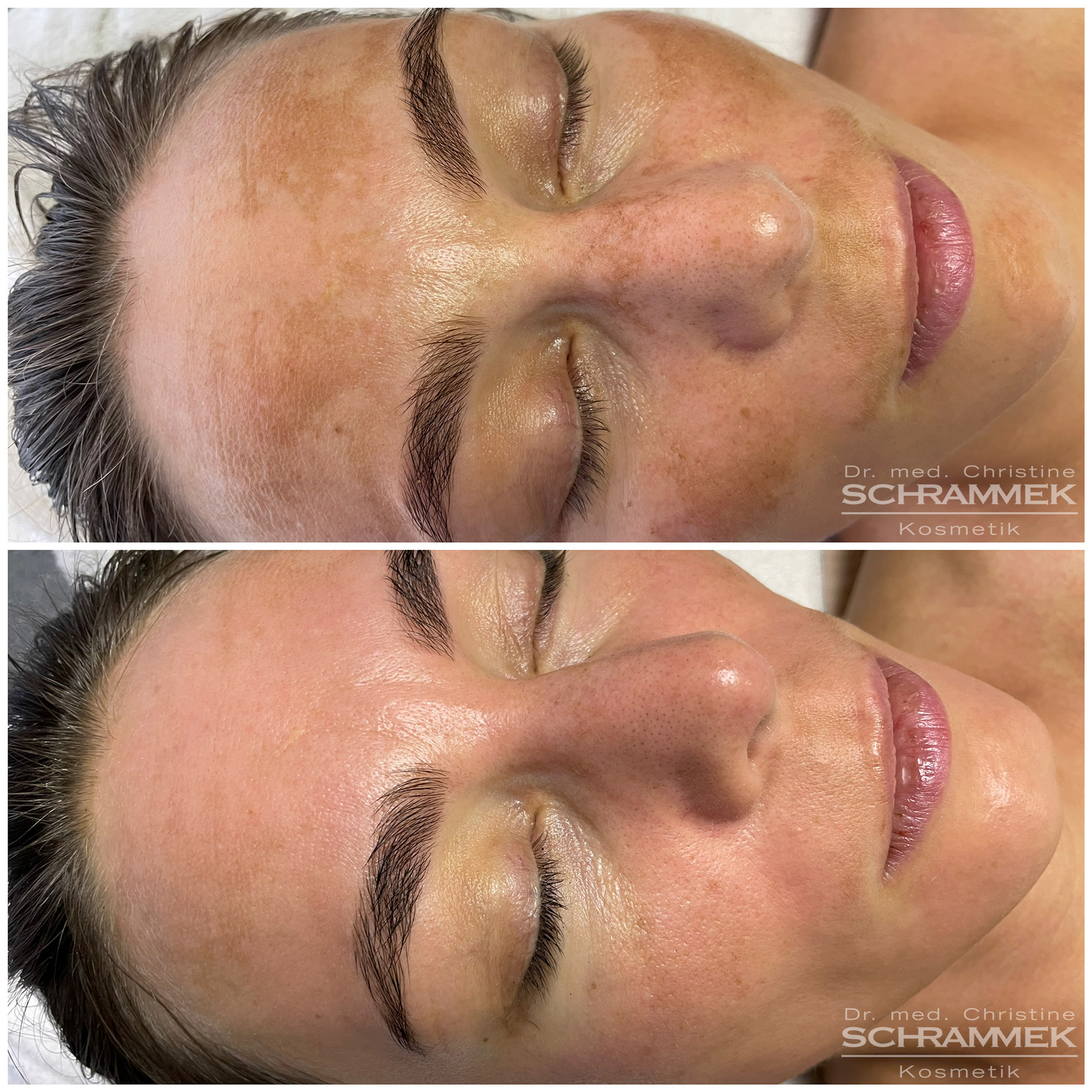Pigmentfleckenentfernen ohne Laser mit Naturkosmetik. Greenpeel ist eine Problemlöser-Behandlung.