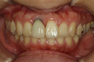インプラントの歯茎が下がってしまった場合は歯茎の再生でお悩み解決！