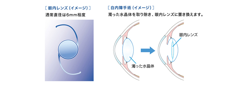 白内障手術