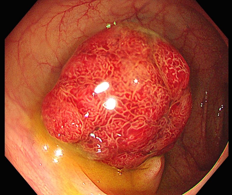 大腸ポリープ(早期大腸癌)