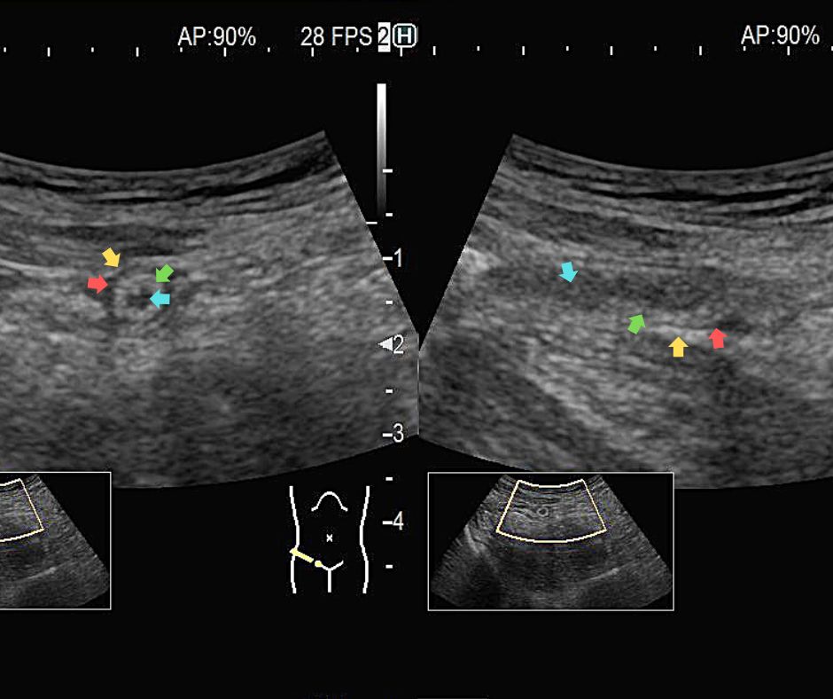 ⑤炎症にて肥厚し、黒‐白‐黒の層構造が確認できる虫垂炎　左(短軸像)　右(長軸像)