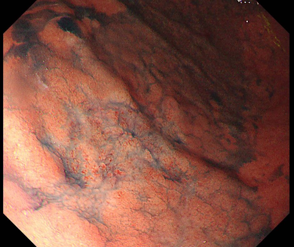 浅い陥凹形態の早期胃癌(色素散布像)