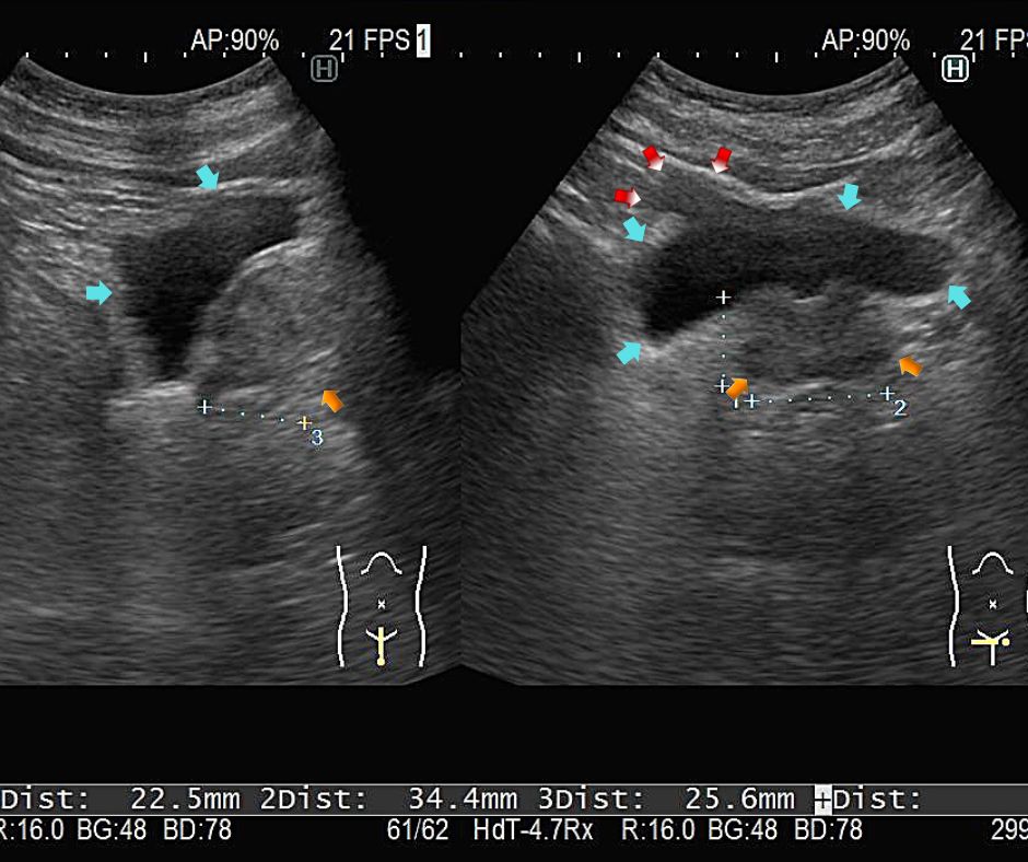 ⑤膀胱憩室(赤色矢印)。黄色矢印は前立腺
