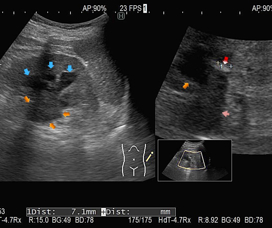 水腎症を認め拡張した腎盂(黄色矢印)と腎杯(水色矢印)と腎内結石(赤色矢印)