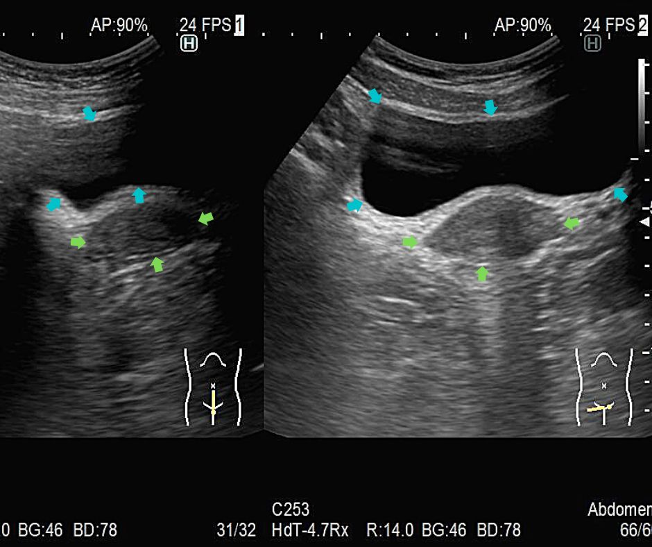 正常の膀胱(水色矢印)は膀胱壁は薄く均一