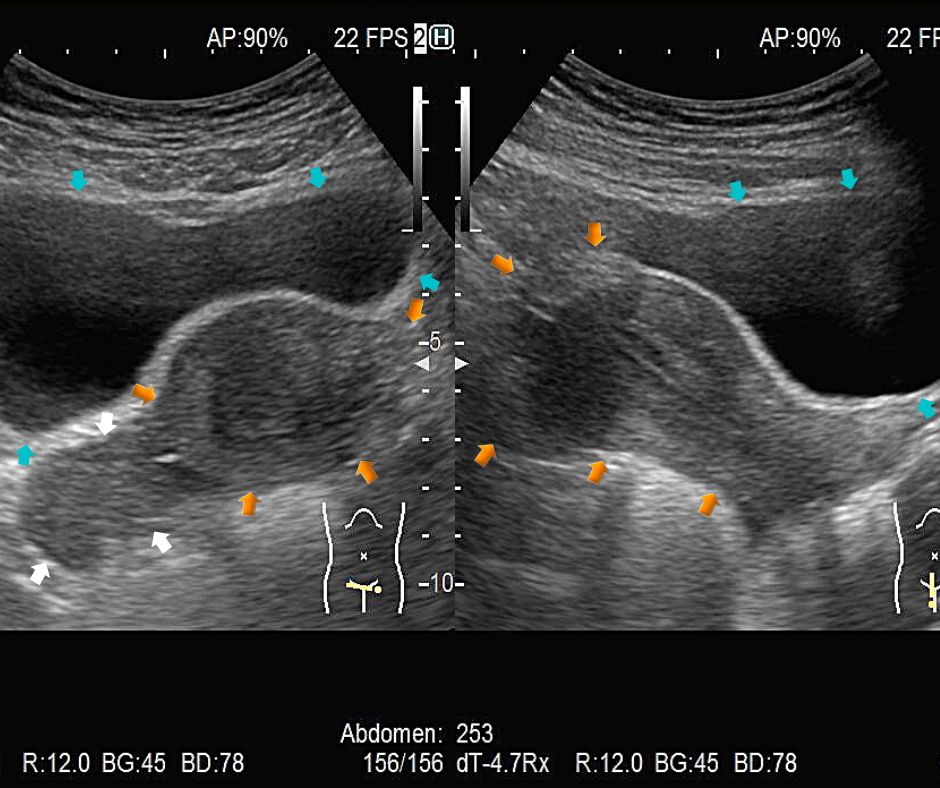 ②子宮(黄色矢印)は膀胱(水色矢印)の背側にある