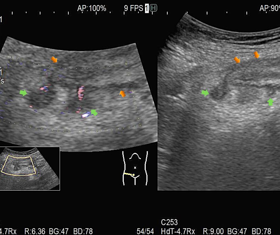 肥厚した大腸(黄色矢印)と、突出する憩室炎を起こした憩室(緑色矢印)