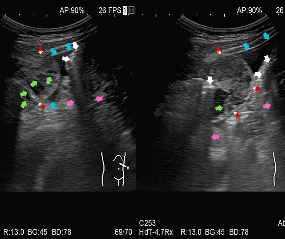 ⑧腸閉塞をきたした小腸(赤色矢印)内に小腸ヒダ(緑色矢印)を認め、腸管の間には少量腹水(水色矢印)