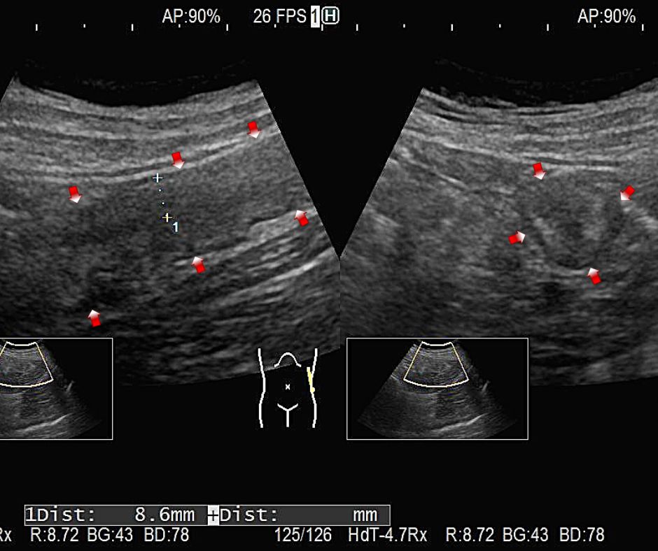 虚血性大腸炎による連続性壁肥厚。左(長軸像)、右(短軸像)