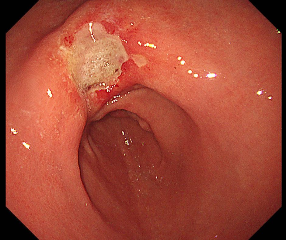 胃癌による潰瘍(がん性潰瘍)