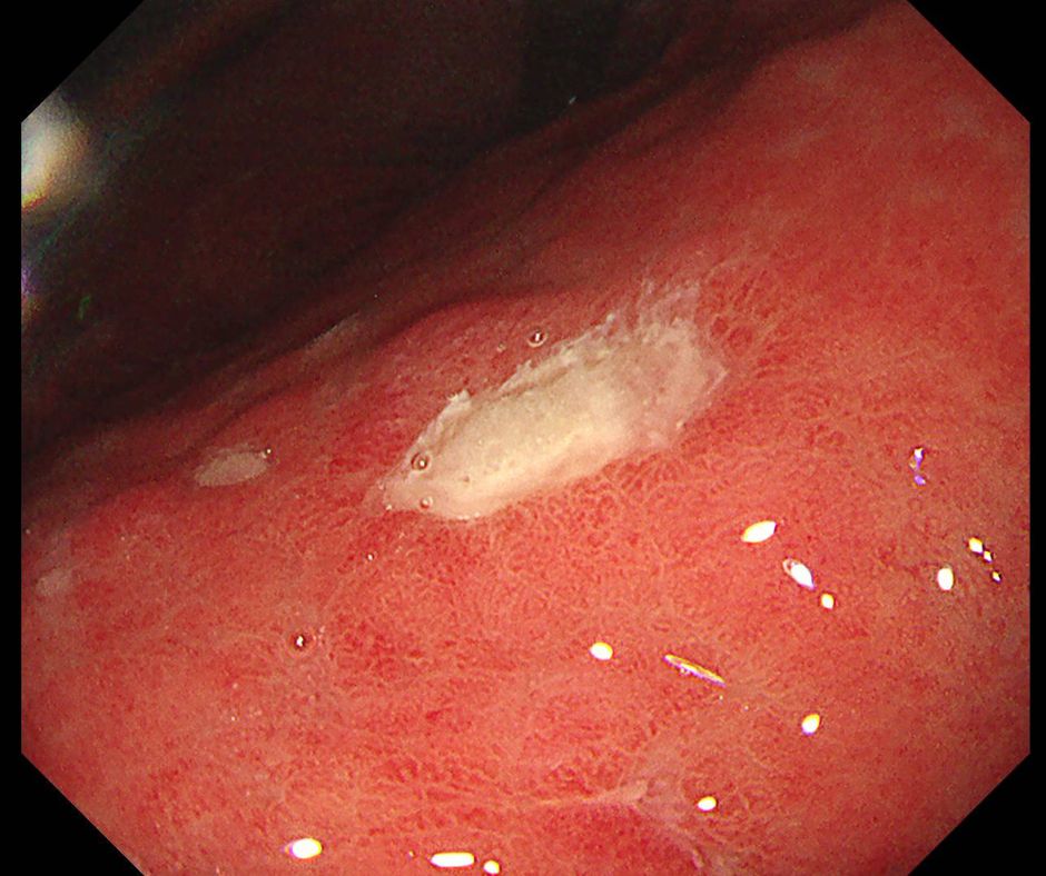 胃角部の胃潰瘍
