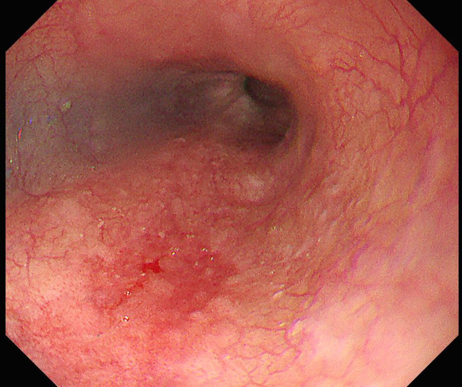 淡い発赤調の早期食道癌