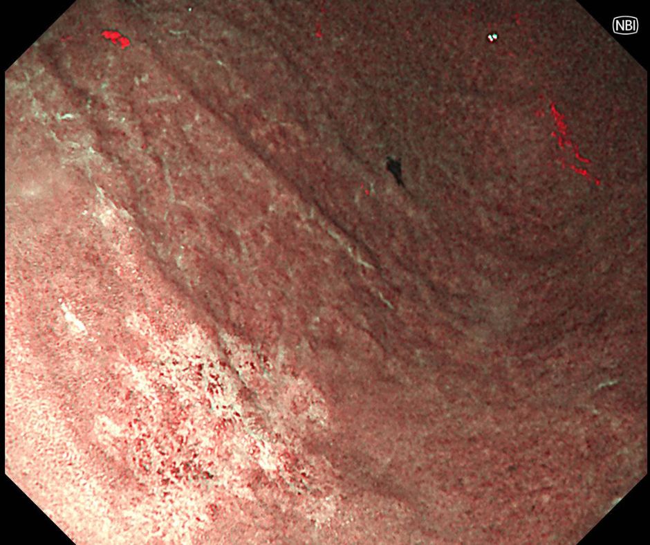 早期胃癌の特殊光像