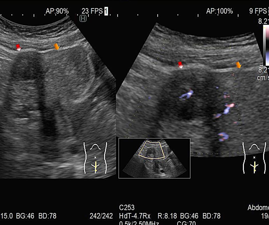 ②黒色の腫瘤(赤色矢印)が子宮から突出している