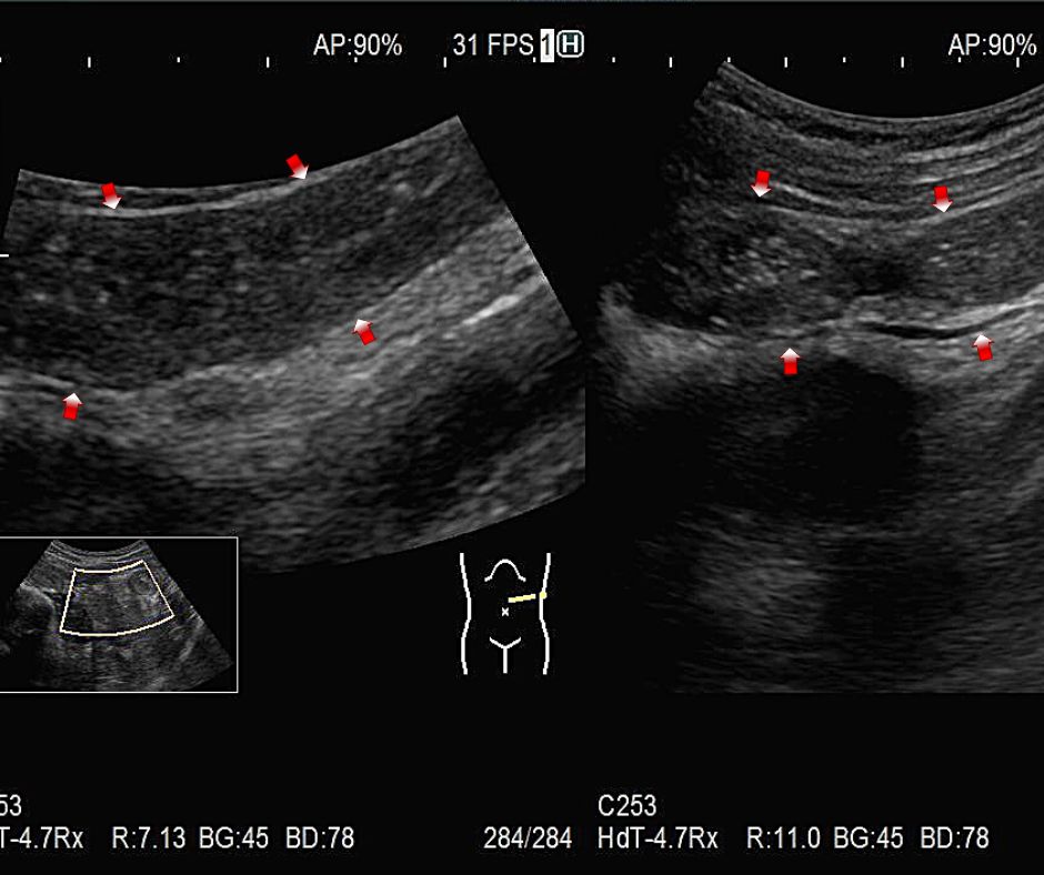 ④拡張した小腸(赤色矢印)内の腸液には一部粒状の内容物の浮遊を認める