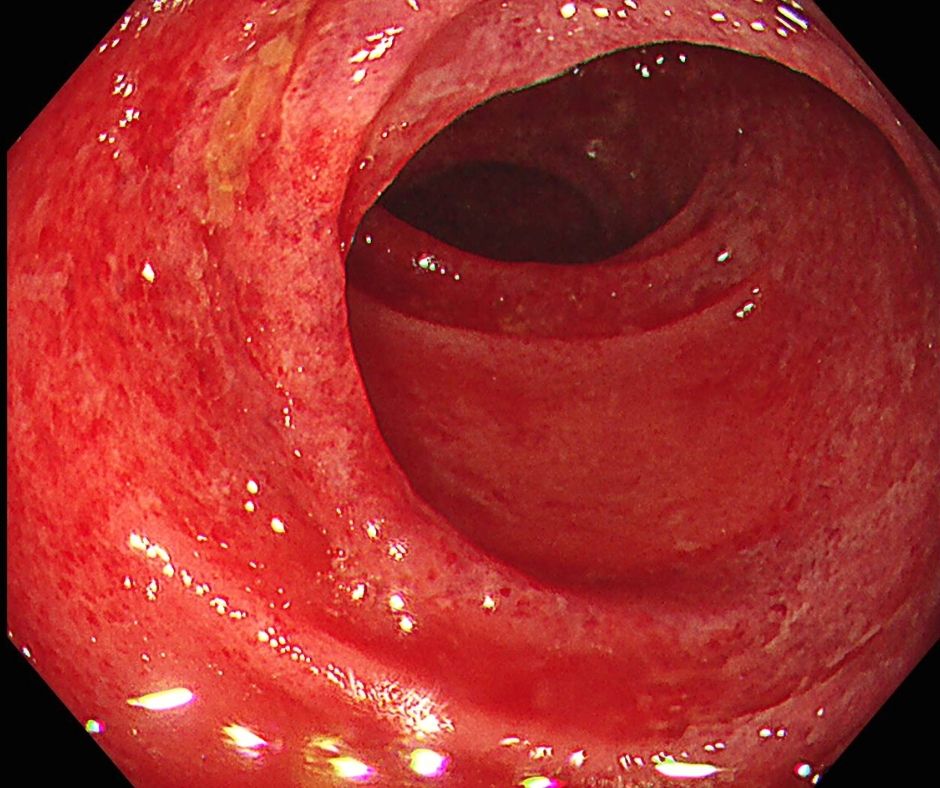 虚血性大腸炎による粘膜障害