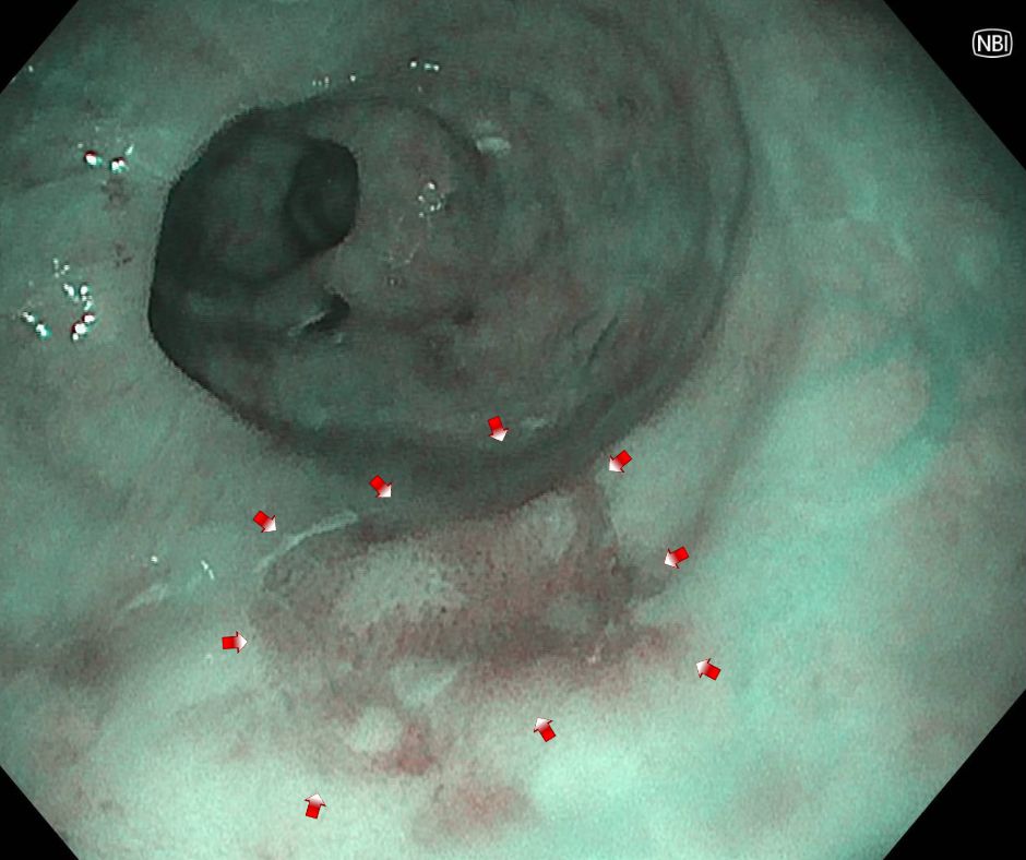 経鼻内視鏡での早期食道癌NBI画像