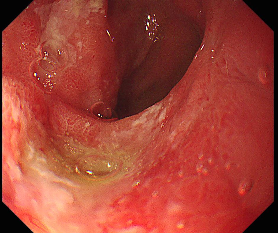 十二指腸球部の下壁の潰瘍