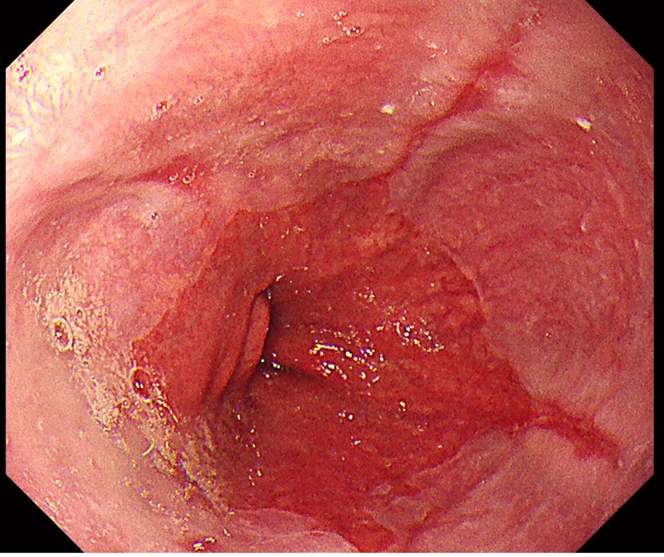 逆流性食道炎の炎症による線状びらん