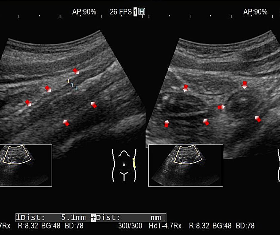 比較的層構造が保たれている左半結腸型の潰瘍性大腸炎。左は長軸像、右は短軸像