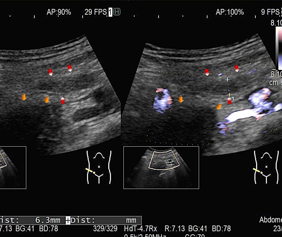 腸腰筋(黄色矢印)の前を横切る腫大した虫垂(赤色矢印)