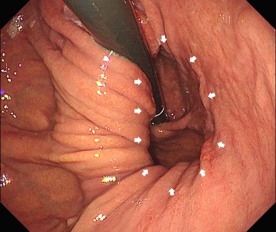 食道裂孔ヘルニアの内視鏡像(白色矢印)