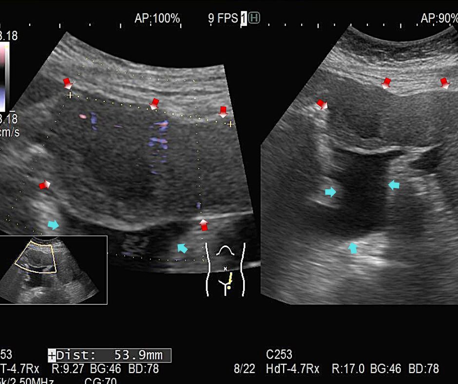 ⑲内部に真っ黒に見える嚢胞成分を含み一塊になった卵巣の悪性腫瘍(赤色矢印)