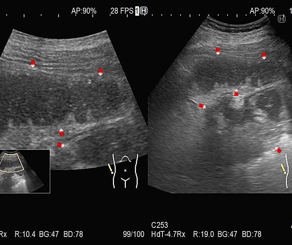 エコーにて腸液が貯留し拡張した小腸(赤色矢印)