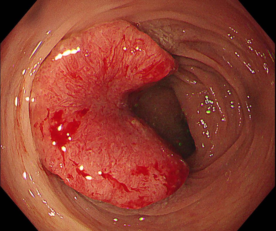 進行大腸癌