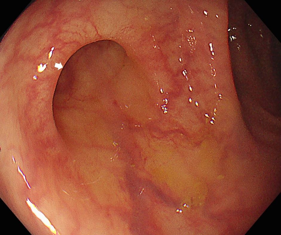 大腸憩室の内視鏡像(白色矢印)
