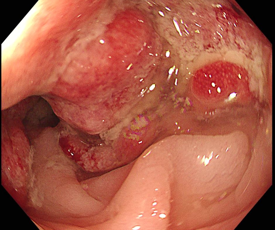 進行大腸癌により大腸は閉塞している