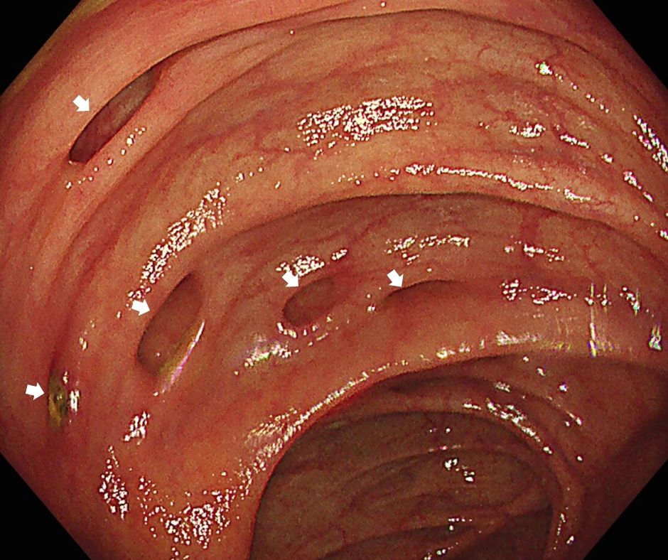 ①大腸憩室の内視鏡像(白色矢印)