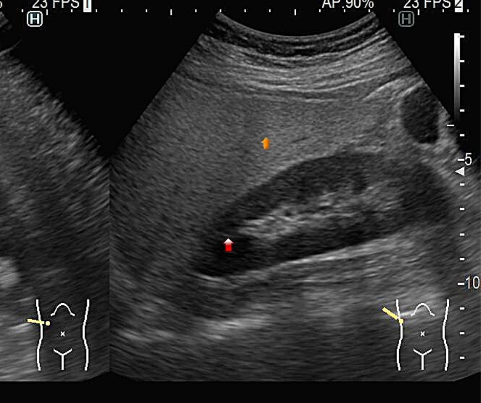 脂肪肝では肝臓に脂肪が蓄積するため肝臓(黄色矢印)が腎臓の皮質(赤色矢印)に比べてエコーで白く見える