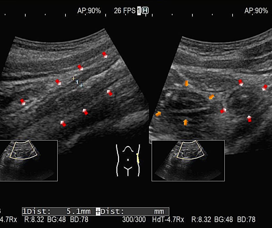 ⑥下行結腸(赤色矢印)から左側の横行結腸(黄色矢印)は層構造が保たれた連続性壁肥厚　左(長軸像)　右(短軸像)