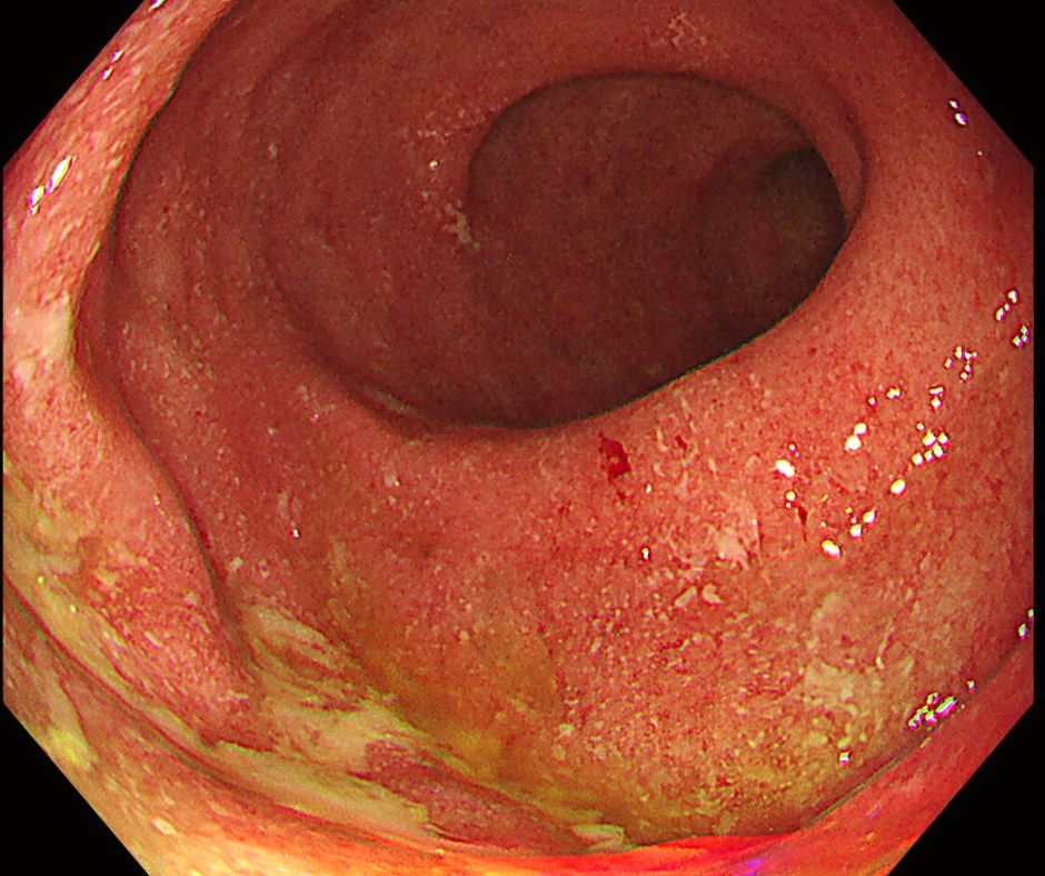潰瘍性大腸炎の内視鏡像