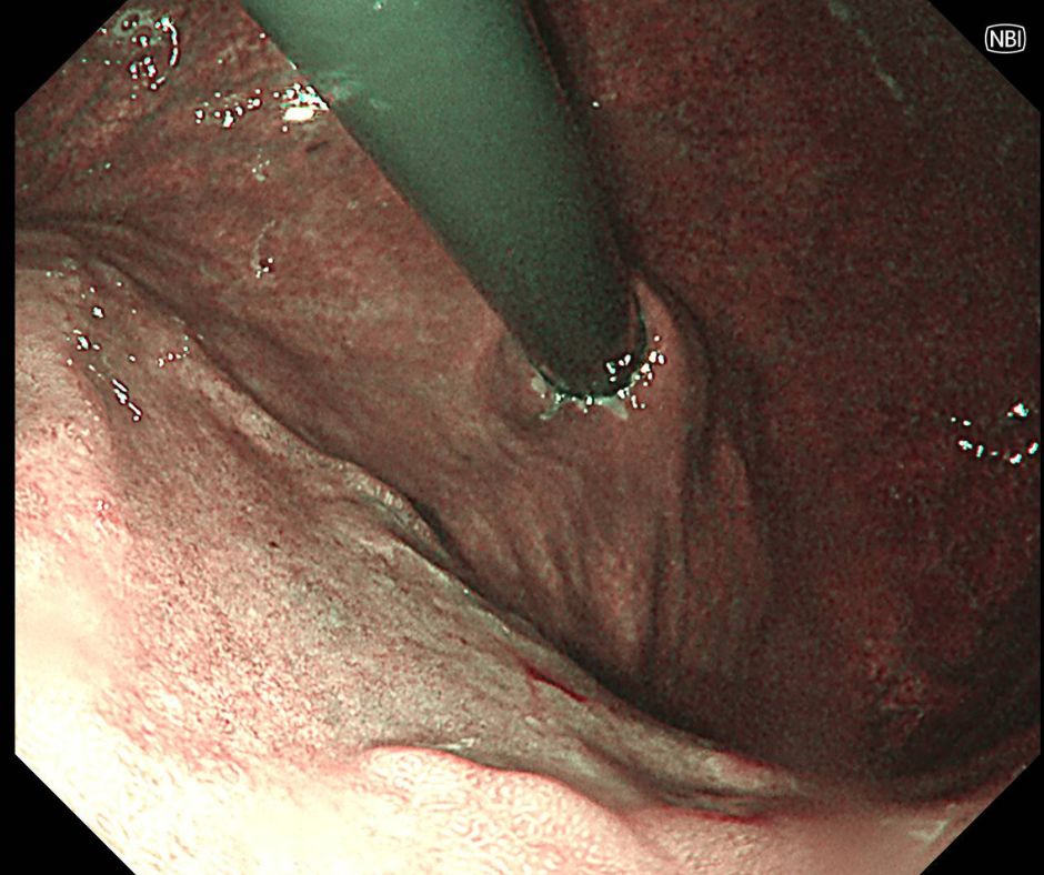 早期胃癌(特殊光像)