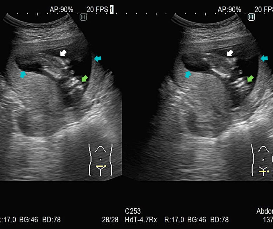 ⑫妊娠16週。頭部(緑色矢印)と体部(白色矢印)が見える