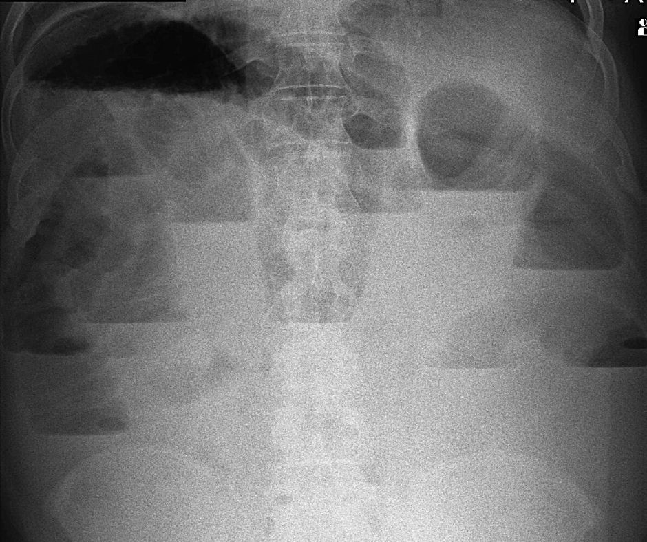 腸閉塞にて拡張した小腸は腸液が鏡面像を示す