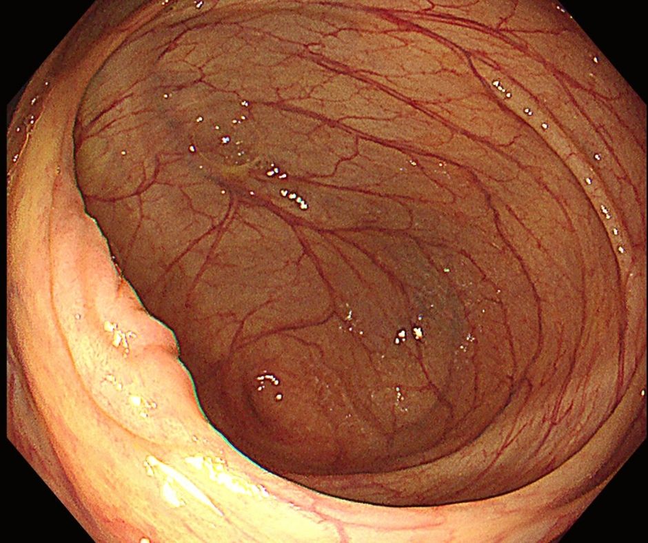 過敏性腸症候群は内視鏡検査では正常