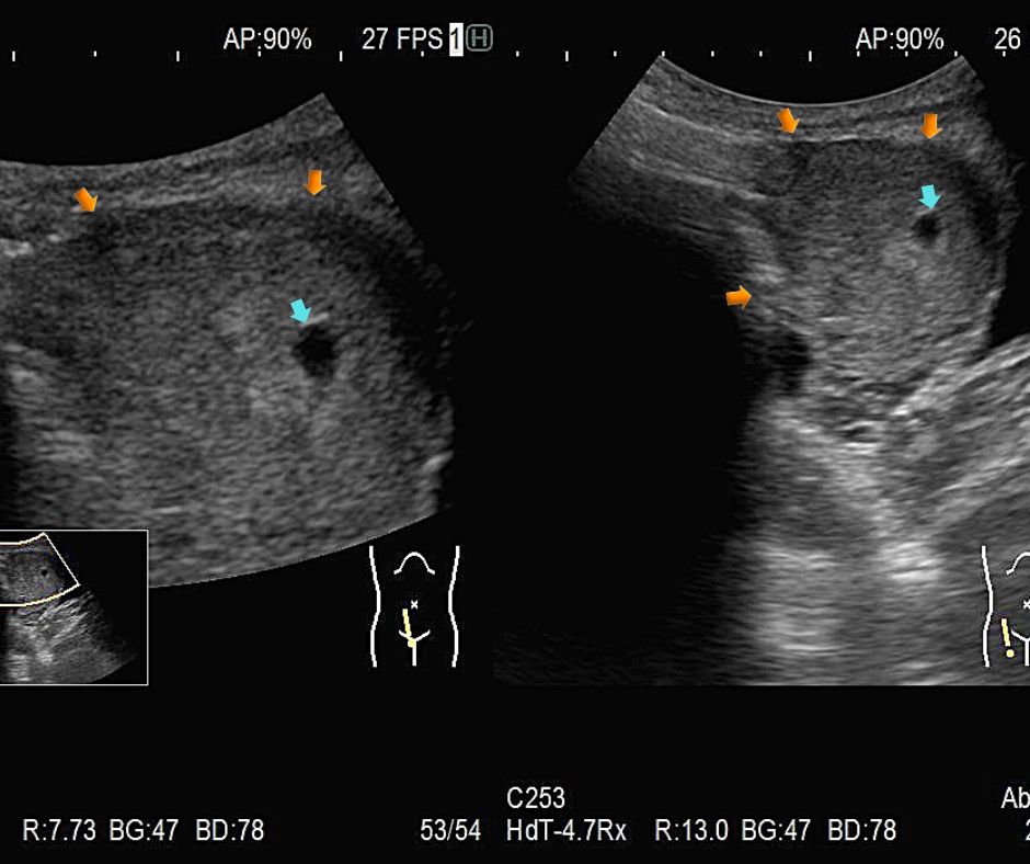⑥妊娠5週の子宮(黄色矢印)。中に胎嚢(水色矢印)が見える