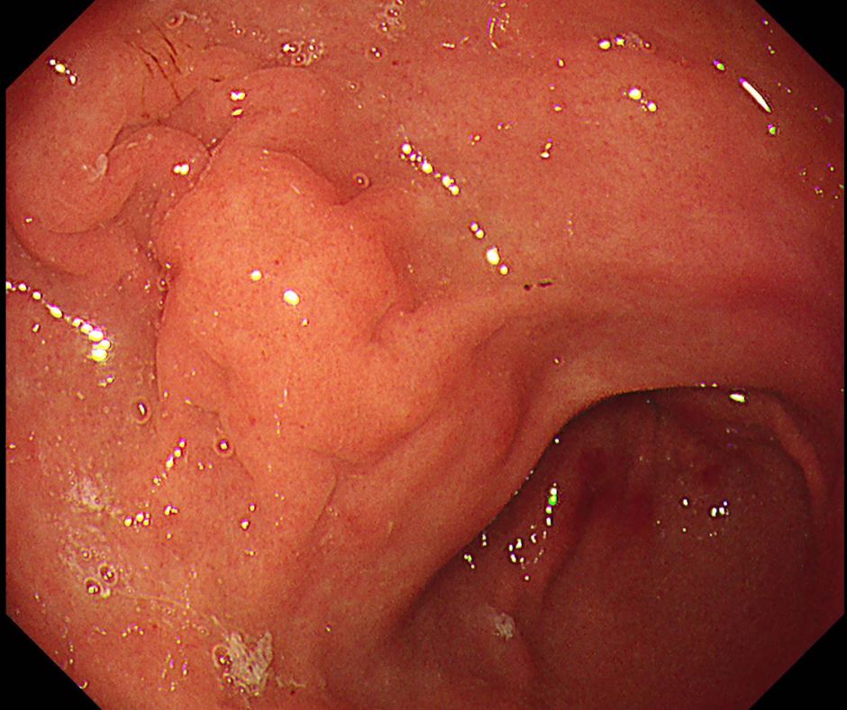 ⑱胃粘膜は浮腫性の肥厚