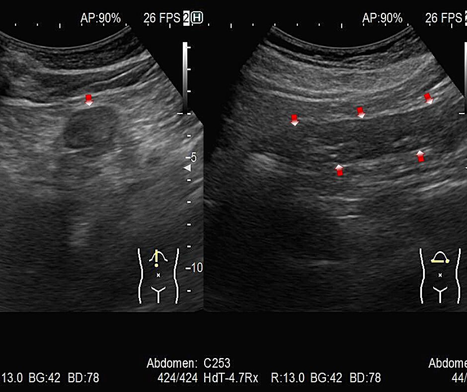 ⑫虚血性大腸炎による左側横行結腸の壁肥厚　左は短軸像　右は長軸像