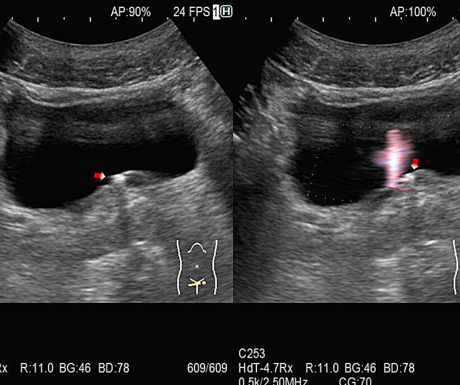 膀胱移行部にある背後に影を引く尿管結石(赤色矢印)