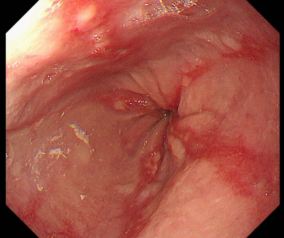 数条の帯状粘膜障害を認める逆流性食道炎